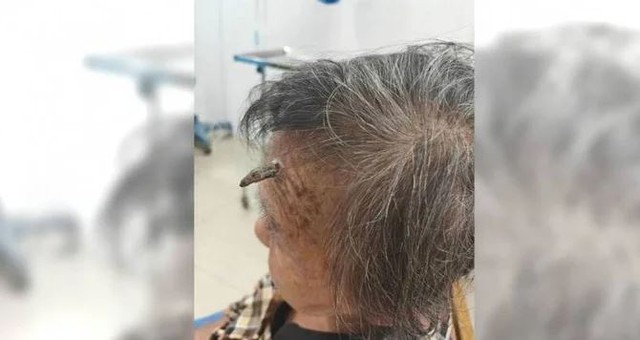 Cụ bà 98 tuổi bất ngờ "mọc sừng" trên trán - Ảnh 1.