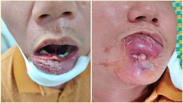 Người đàn ông 40 tuổi nhập viện với phần môi sưng tấy vì mắc sai lầm phổ biến - Ảnh 1.