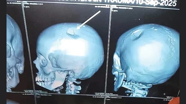 Con gái kêu đau đầu dữ dội, mẹ đưa đi chụp CT thì sốc nặng- Ảnh 1.