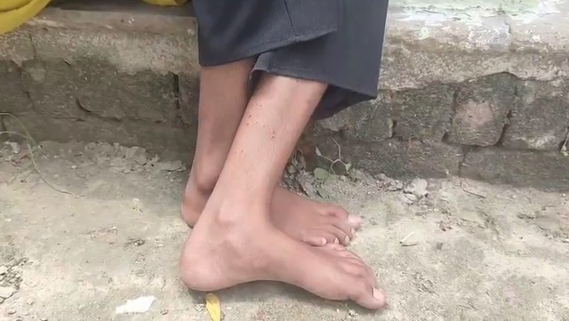 Bé gái bị rắn cắn 9 lần trong vòng 40 ngày- Ảnh 1. Bé gái bị rắn cắn 9 lần trong vòng 40 ngày- Ảnh 1.