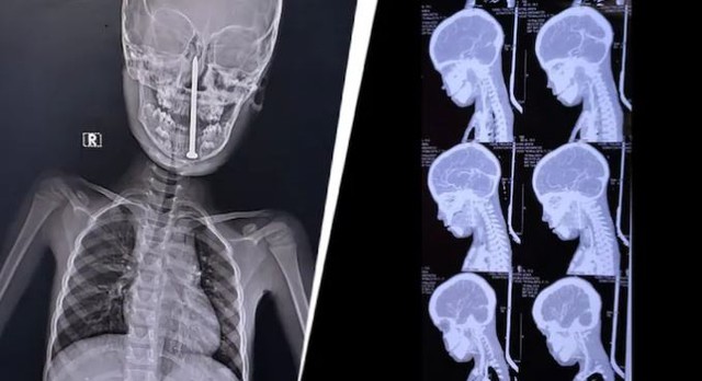 Phẫu thuật cho bé trai 7 tuổi, bác sĩ sốc nặng khi lấy ra "thứ đáng sợ" - Ảnh 1.
