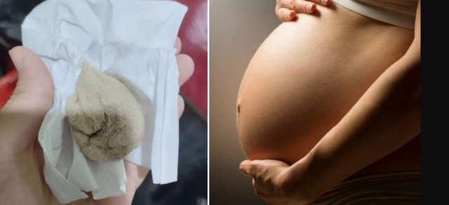 Đau vùng kín suốt 1 tháng sau sinh,người phụ nữ sốc nặng khi phát hiện "vật lạ" trong cơ thể - Ảnh 1.