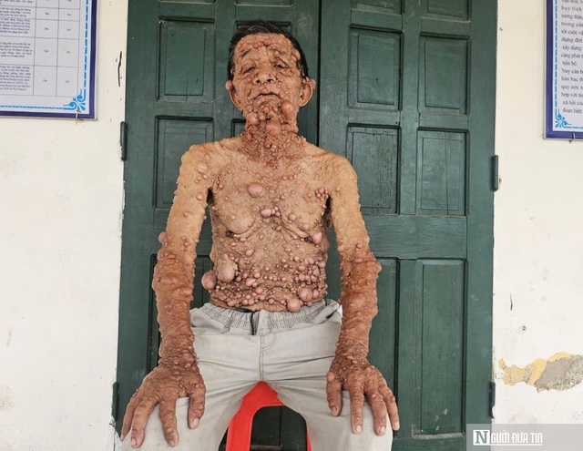 Mắc căn bệnh "lạ", nổi u cục khắp người, cụ ông bị cắt chế độ bảo trợ xã hội- Ảnh 1.