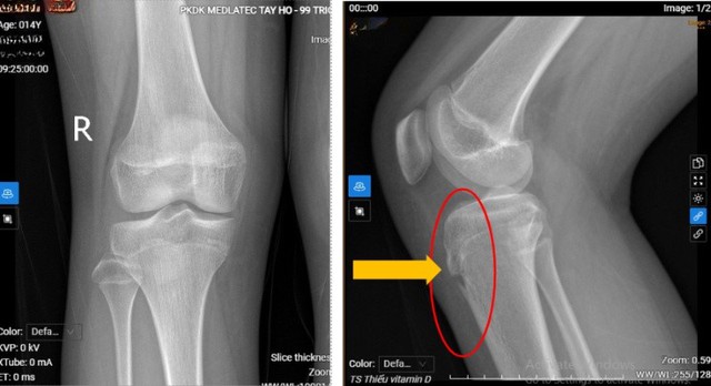 "Thủ phạm" khiến bé gái 14 tuổi bỗng dưng đau khớp gối - Ảnh 1.