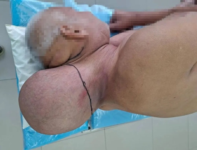 Người đàn ông 65 tuổi mang khối u hình đầu người khổng lồ suốt 16 năm - Ảnh 1.