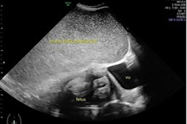 Siêu âm cho thai phụ, bác sĩ sốc nặng khi thấy thứ bên trong - Ảnh 1.