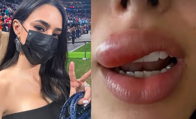 Bạn gái Neymar lên tiếng sau khi khiến fan lo lắng, chia sẻ gương mặt sưng tấy - Ảnh 1.