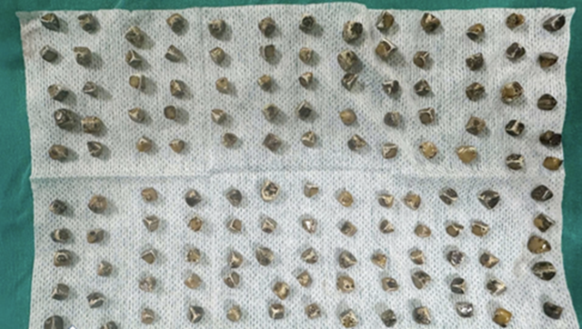 Đau bụng đi kh&aacute;m, người phụ nữ 40 tuổi sốc khi b&aacute;c sĩ gắp ra thứ "đ&aacute;ng sợ" b&ecirc;n trong - Ảnh 1.