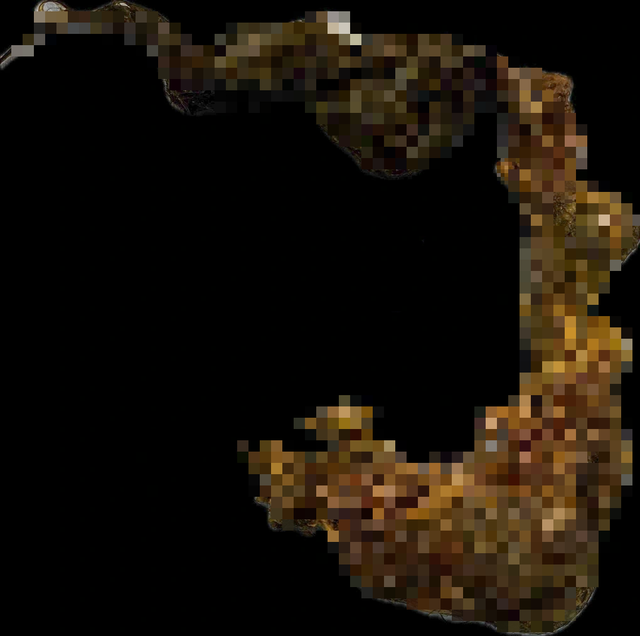 B&eacute; g&aacute;i 9 tuổi c&oacute; th&oacute;i quen lạ đời, b&aacute;c sĩ gắp ra thứ "đ&aacute;ng sợ" trong bụng - Ảnh 1.