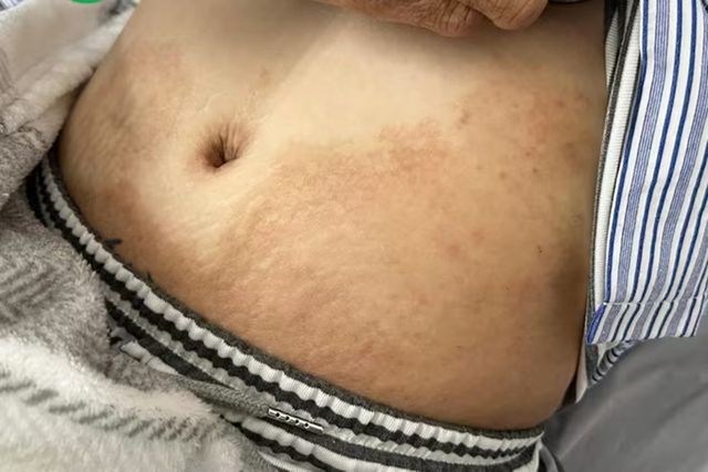 Thường xuy&ecirc;n ăn m&oacute;n "vạn người m&ecirc;", c&ocirc; g&aacute;i trẻ sốc khi biết nhiễm 4 loại k&yacute; sinh tr&ugrave;ng - Ảnh 1.