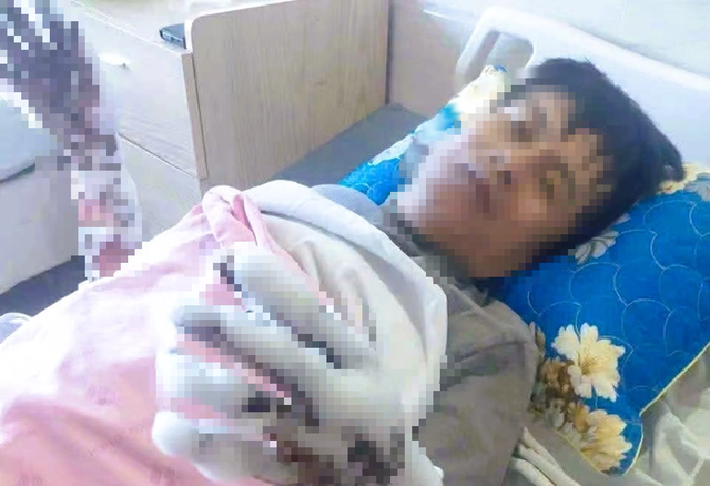 Bị ph&oacute;ng điện, người đ&agrave;n &ocirc;ng bị bỏng nặng - Ảnh 1.