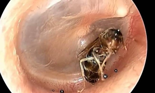 Đi kh&aacute;m, b&aacute;c sĩ sốc nặng khi thấy thứ b&ecirc;n trong tai người đ&agrave;n &ocirc;ng - Ảnh 1.