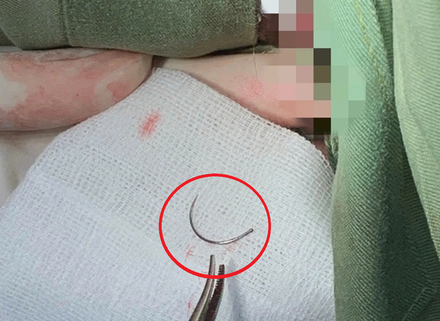 Kim kh&acirc;u "mắc kẹt" 11 năm, người phụ nữ đến viện cầu cứu - Ảnh 1.