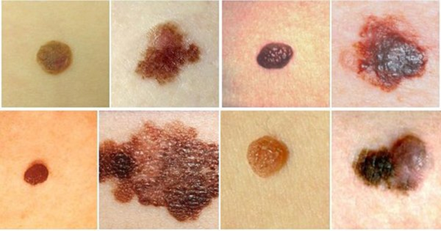 5 dấu hiệu nhận biết nốt ruồi c&oacute; nguy cơ &aacute;c t&iacute;nh, ung thư, nhất c&aacute;i số 1 kh&ocirc;ng phải ai cũng biết - Ảnh 1.