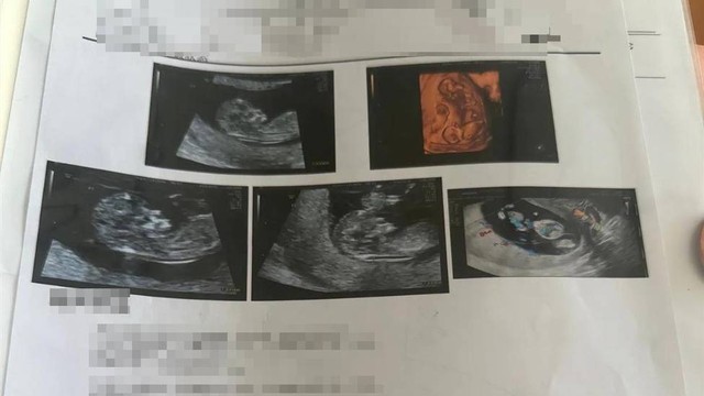 Đi kh&aacute;m thai, người phụ nữ sốc nặng sau khi si&ecirc;u &acirc;m - Ảnh 1.