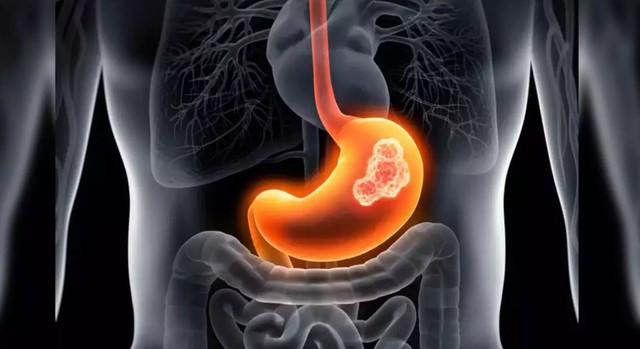 Có dấu hiệu này suốt nửa năm nhưng không đi khám, thanh niên 17 tuổi mắc ung thư giai đoạn cuối - Ảnh 1.