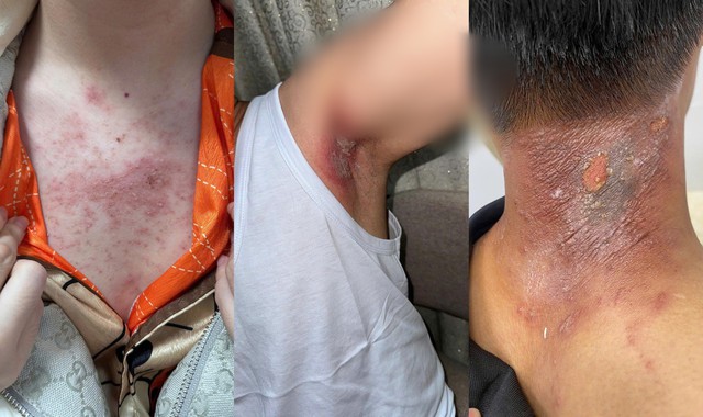 Kiến ba khoang "v&agrave;o m&ugrave;a", cẩn trọng dễ nhầm với zona thần kinh - Ảnh 1.