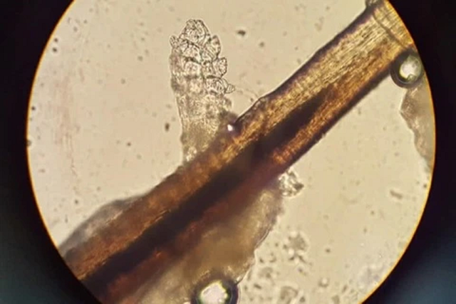 Người phụ nữ 24 tuổi kh&oacute; chịu ở m&iacute; mắt, b&aacute;c sĩ sốc khi gắp ra thứ "đ&aacute;ng sợ" chi ch&iacute;t tr&ecirc;n mi- Ảnh 1.