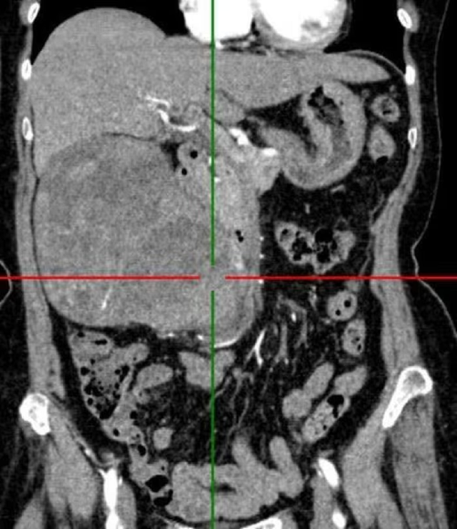 Cụ bà 72 tuổi đau âm ỉ nhiều ngày, bác sĩ sốc khi lấy ra thứ "đáng sợ" bên trong - Ảnh 1.