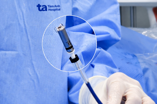 Lần đầu tiên tại Việt Nam, Bệnh viện Tâm Anh triển khai kỹ thuật tạo nhịp không dây thế hệ mới - Ảnh 3.