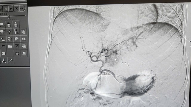 Người đ&agrave;n &ocirc;ng 31 tuổi bị tạ rơi tr&uacute;ng bụng l&agrave;m vỡ gan độ 4 - Ảnh 1.