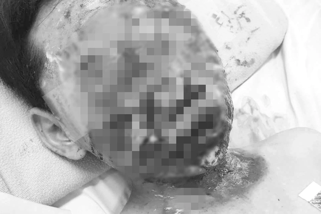 Mối hiểm họa từ ph&aacute;o tự chế lại gia tăng: Một tiếng nổ cho vui, cả đời trả gi&aacute; - Ảnh 1.