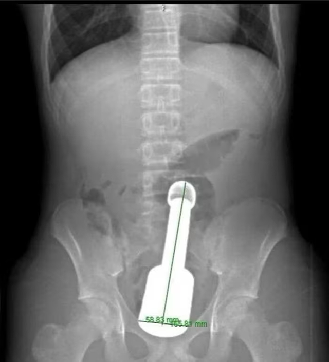 Nam thanh ni&ecirc;n 15 tuổi đau bụng dữ dội, b&aacute;c sĩ gắp ra thứ "đ&aacute;ng sợ" b&ecirc;n trong  - Ảnh 1.