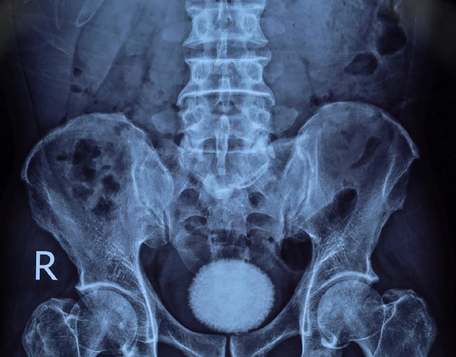 Người đ&agrave;n &ocirc;ng 50 tuổi đau hạ vị k&eacute;o d&agrave;i, b&aacute;c sĩ sốc khi gắp ra thứ "đ&aacute;ng sợ" bằng quả trứng ngỗng- Ảnh 1.