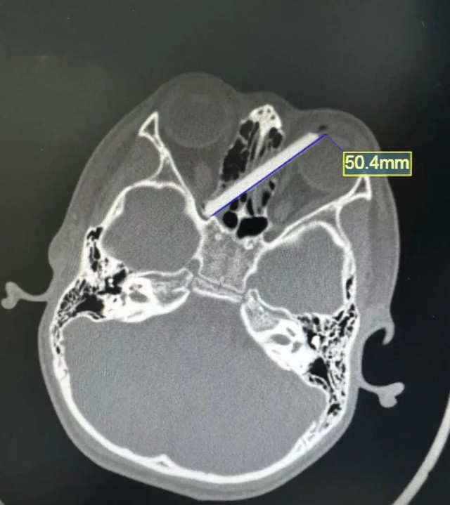 Bé trai đau mắt dữ dội, bác sĩ lấy ra thứ "đáng sợ" bên trong - Ảnh 1.
