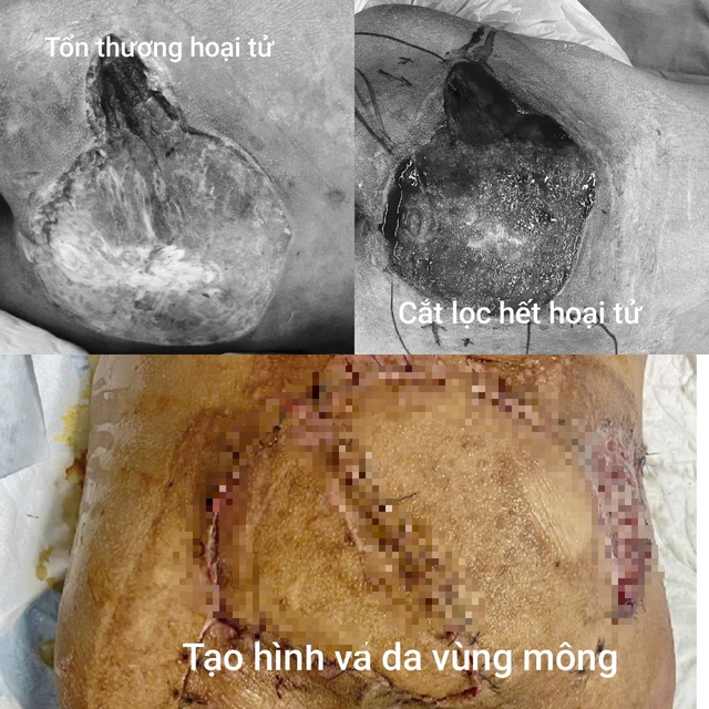 Hoại tử gần 60% v&ugrave;ng m&ocirc;ng chỉ v&igrave; chủ quan với một nốt nhọt - Ảnh 1.