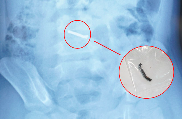 Bé trai 5 tuổi nuốt hàng chục viên nam châm gây thủng ruột - Ảnh 1.