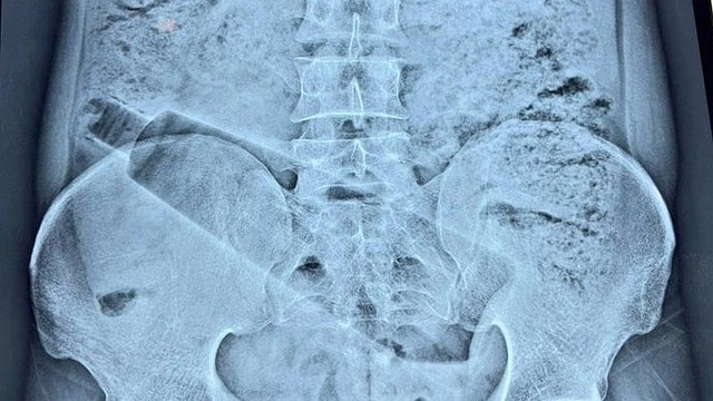 Người đ&agrave;n &ocirc;ng đau bụng 36 tiếng, b&aacute;c sĩ ph&aacute;t hiện "b&iacute; mật" b&ecirc;n trong - Ảnh 1.