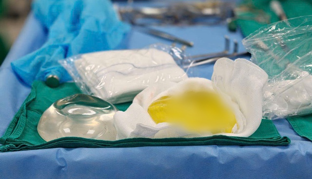 Vỡ t&uacute;i ngực cả năm m&agrave; kh&ocirc;ng hay biết, b&aacute;c sĩ cảnh b&aacute;o biến chứng &acirc;m thầm - Ảnh 1.