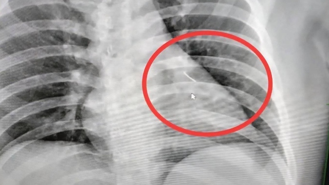 Người đ&agrave;n &ocirc;ng bị đau ngực, b&aacute;c sĩ sốc nặng khi ph&aacute;t hiện ra thứ b&ecirc;n trong - Ảnh 1.