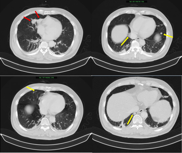 Người đ&agrave;n &ocirc;ng 63 tuổi sốc nặng khi ph&aacute;t hiện mắc hai bệnh ung thư c&ugrave;ng l&uacute;c - Ảnh 1.
