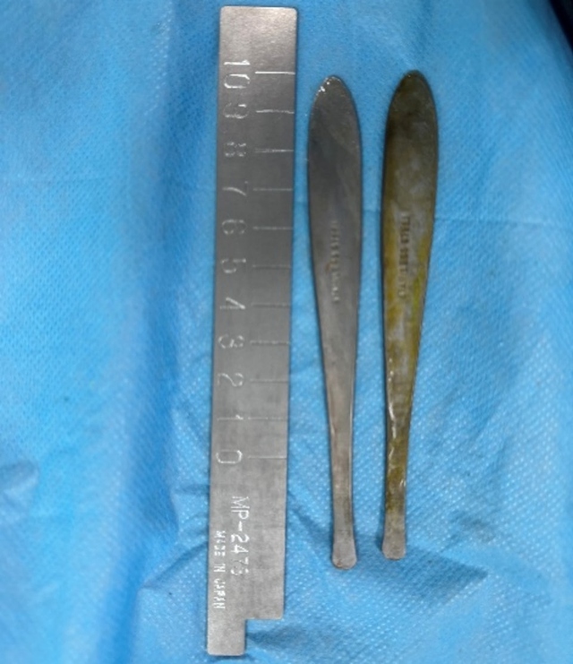 Người đàn ông đau bụng suốt 1 tuần, bác sĩ kiểm tra thì sốc nặng - Ảnh 2.