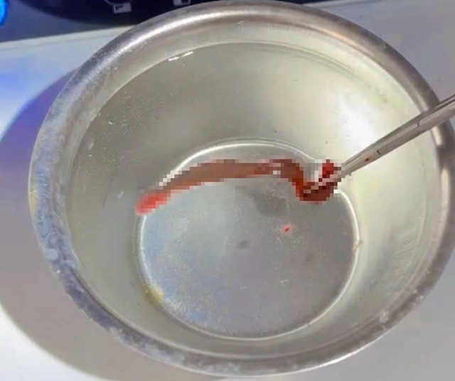 Người đ&agrave;n &ocirc;ng 53 tuổi chảy m&aacute;u mũi li&ecirc;n tục, b&aacute;c sĩ ph&aacute;t hiện ra thứ "đ&aacute;ng sợ" ẩn n&aacute;u b&ecirc;n trong - Ảnh 2.