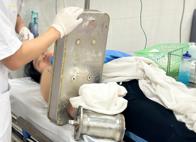 Bàn tay mắc kẹt trong máy xay thịt, người phụ nữ trẻ sốc khi phải cắt cụt chi - Ảnh 1.