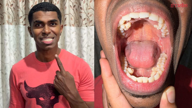 Người đ&agrave;n &ocirc;ng nhiều răng nhất thế giới, b&aacute;c sĩ l&yacute; giải nguy&ecirc;n nh&acirc;n chuyện "xưa nay hiếm" - Ảnh 1.