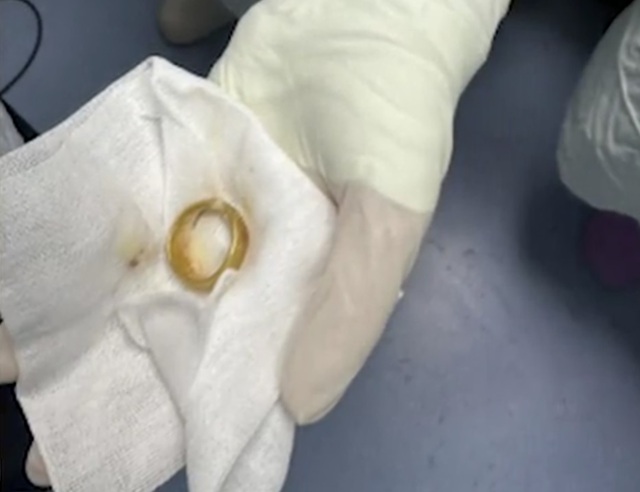 Cụ &ocirc;ng bị vi&ecirc;m phổi, b&aacute;c sĩ sốc nặng khi lấy ra thứ trong thực quản - Ảnh 1.