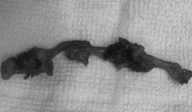 Đau âm ỉ vùng bụng, người đàn ông sốc nặng khi bác sĩ lấy ra thứ "rợn người" trong cơ thể - Ảnh 1.