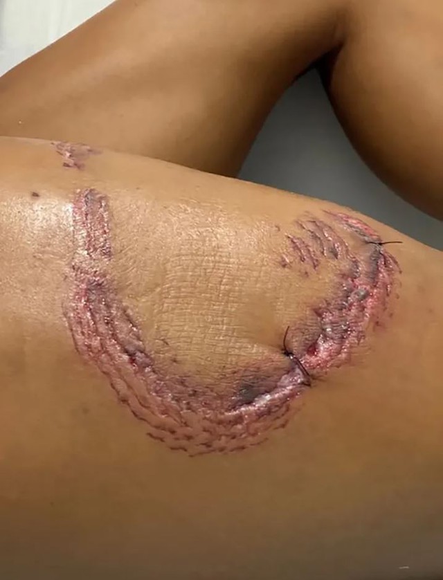 Người phụ nữ bị c&aacute; mập ngoạm v&agrave;o ch&acirc;n khi đang lặn biển - Ảnh 2.