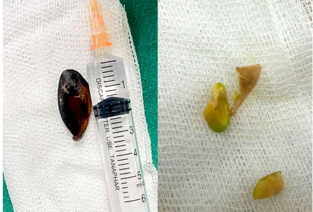 Bé 14 tuổi ho khan kéo dài, gia đình sốc khi bác sĩ lấy ra dị vật bên trong cơ thể- Ảnh 1. Bé 14 tuổi ho khan kéo dài, gia đình sốc khi bác sĩ lấy ra dị vật bên trong cơ thể- Ảnh 1.