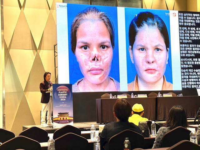 Giải ph&aacute;p điều trị biến chứng sau n&acirc;ng mũi g&acirc;y ch&uacute; &yacute; tại Hội nghị thẩm mỹ quốc tế APS Korea 2026 - Ảnh 1.