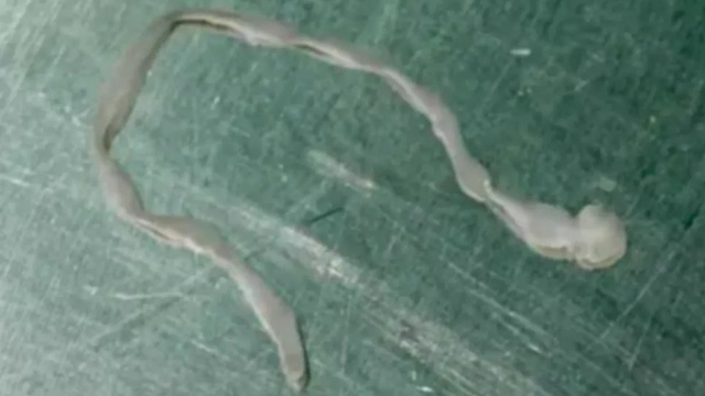 Người phụ nữ l&ecirc;n cơn co giật, b&aacute;c sĩ lấy ra thứ đ&aacute;ng sợ trong n&atilde;o - Ảnh 1.