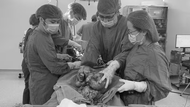 Đau &acirc;m ỉ v&ugrave;ng bụng suốt, người phụ nữ sốc khi b&aacute;c sĩ lấy ra thứ "đ&aacute;ng sợ" trong cơ thể m&igrave;nh - Ảnh 1.