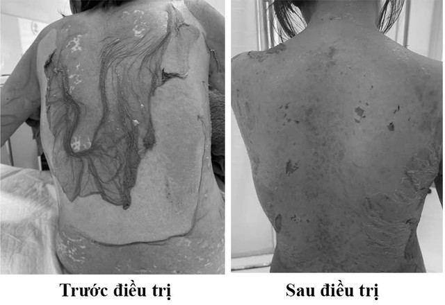 Người phụ nữ 35 tuổi da bị tr&oacute;c da như "cua lột" v&igrave; một sai lầm nhiều người dễ mắc phải - Ảnh 1.