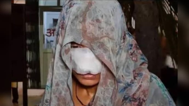 C&atilde;i nhau, chồng cắn v&agrave;o mũi v&agrave; m&aacute; khiến vợ phải kh&acirc;u 10 mũi - Ảnh 1.