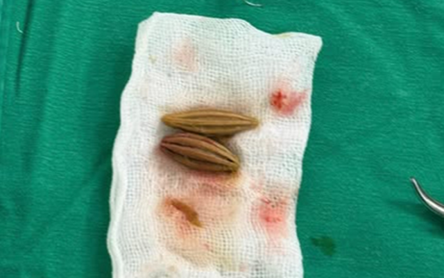 Nuốt nhầm hạt nh&oacute;t, cụ b&agrave; nguy kịch - Ảnh 1.