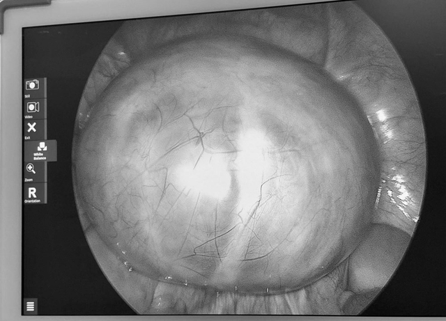 Đau bụng nhưng chủ quan, người phụ nữ sốc khi b&aacute;c sĩ gắp ra thứ "đ&aacute;ng sợ" b&ecirc;n trong - Ảnh 1.
